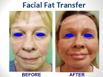 Best Face Surgery India Medical Services | Clinics