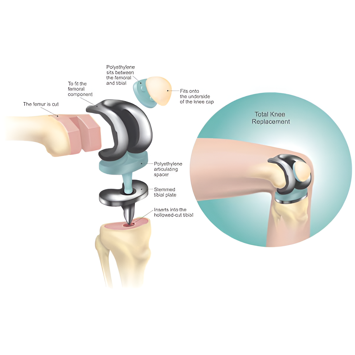 Knee Replacement Surgeon in Ahmedabad Medical Services | Healthcare